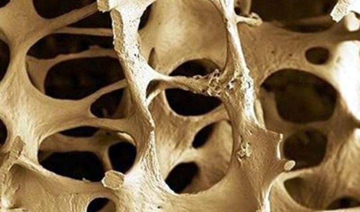 Advierten aumento de osteoporosis en México