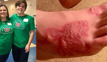 Joven de 17 años sufre infección por enterrarse en la arena en Florida