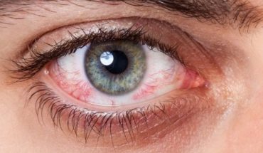 transl: What is and how to prevent dry eye syndrome?