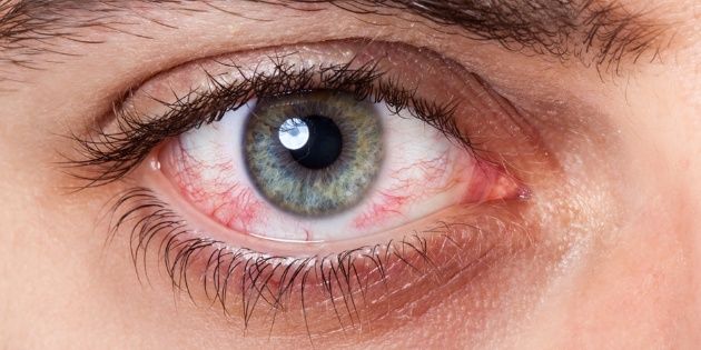 What is and how to prevent dry eye syndrome?