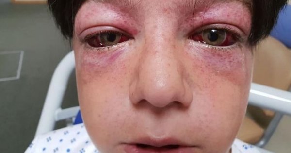 El peligroso reto de YouTube que le causó heridas “vistas en los pilotos de combate” a un niño de 11 años