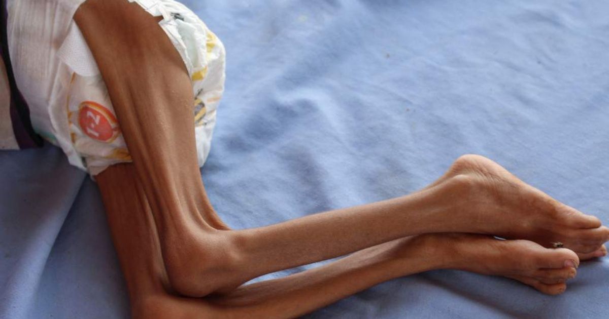 El hambre amenaza la vida de 12 millones de personas en un solo país