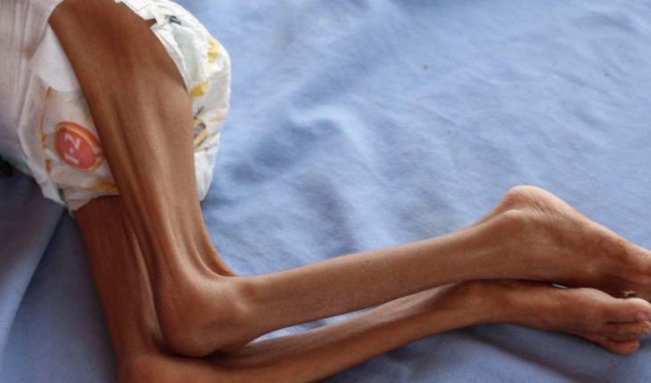 El hambre amenaza la vida de 12 millones de personas en un solo país