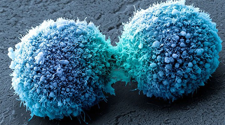 Investigan en Londres nueva cura potencial del cáncer de páncreas mediante "células asesinas"