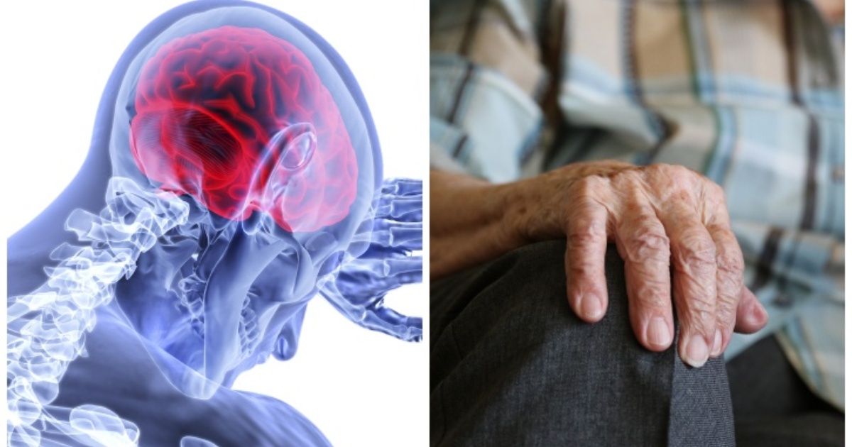 "Marcapasos cerebral" podría tratar epilepsia y párkinson