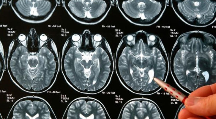 Confundieron su tumor cerebral con una migraña durante 7 años y presenta una demanda multimillonaria contra los doctores