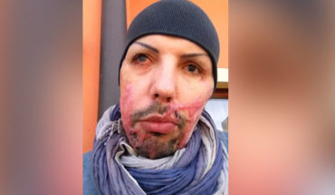 translated from Spanish: Man shows images of his face after being attacked with acid by his ex-girlfriend