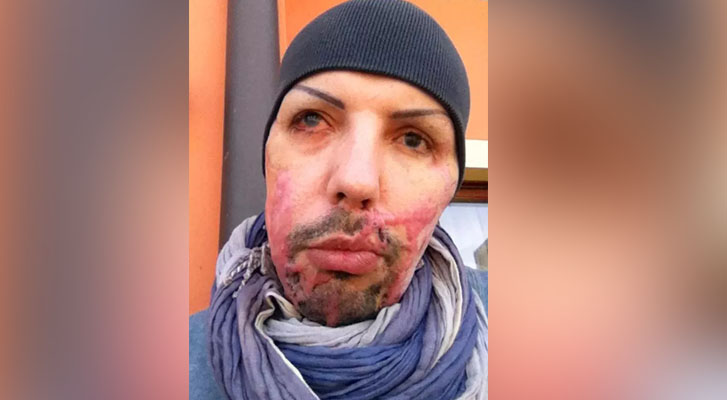Man shows images of his face after being attacked with acid by his ex-girlfriend