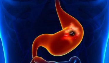 translated from Spanish: World Stomach Day: 3,000 people die each year from gastric cancer in Chile
