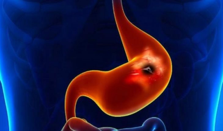 translated from Spanish: World Stomach Day: 3,000 people die each year from gastric cancer in Chile