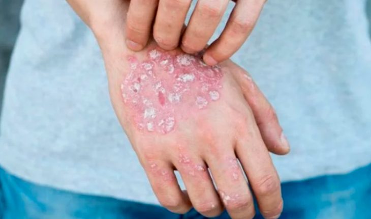 translated from Spanish: They confirm that Psoriasis is not a contagious disease
