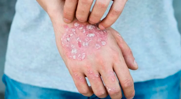 They confirm that Psoriasis is not a contagious disease