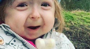 Niña de 2 años sufre la enfermedad de Benjamin Button