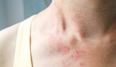 Día Mundial de la Alergia: la atención de alergias no se detiene con COVID-19