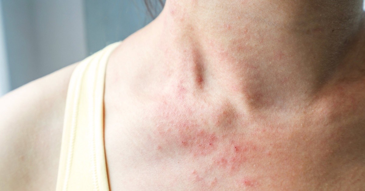 Día Mundial de la Alergia: la atención de alergias no se detiene con COVID-19