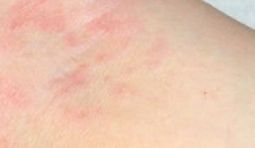 Las erupciones en la piel podrían ser otro síntoma clave del coronavirus