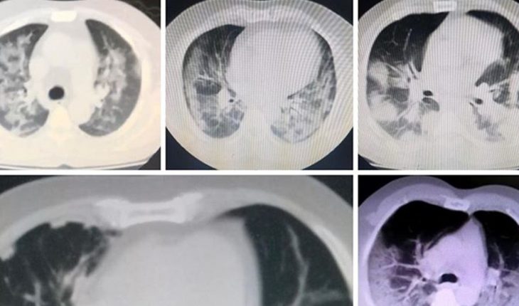 Video | El antes y después de los pulmones con el contagio de Covid-19