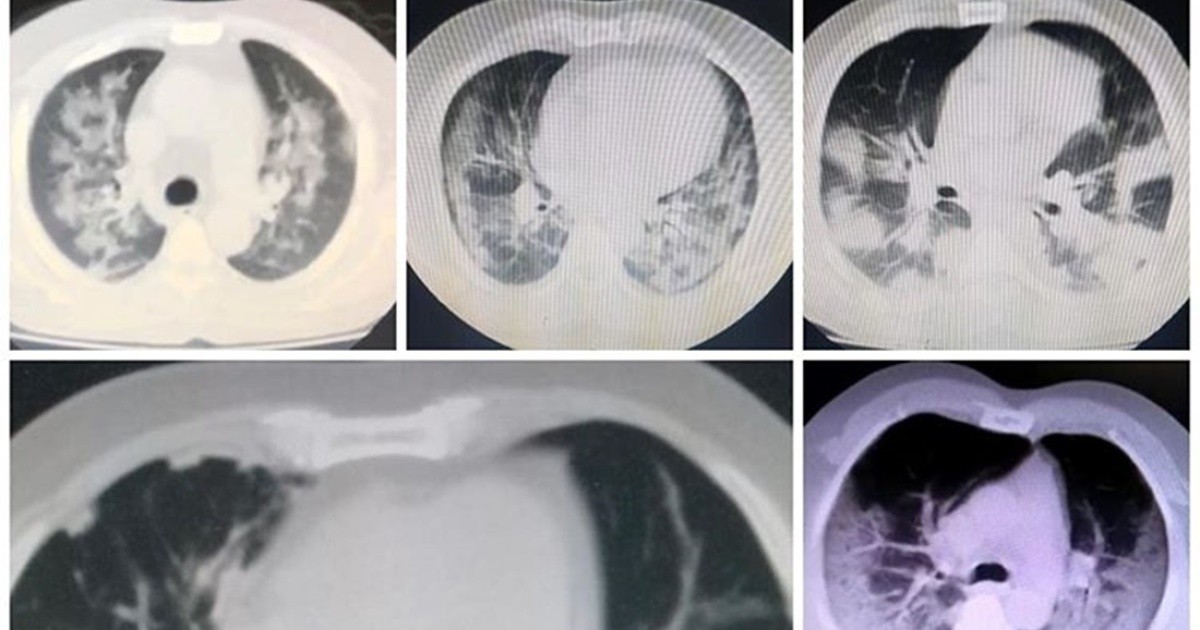 Video | El antes y después de los pulmones con el contagio de Covid-19
