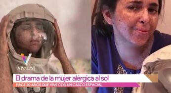 Video: La dramática vida de una mujer por alergia al Sol | Vivalavi