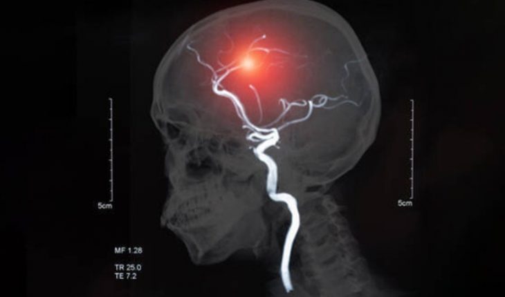 ¿Qué es el accidente cerebrovascular?