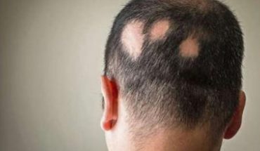 Alopecia: cuándo realmente hay que preocuparse por la caída del pelo y cómo identificarlo
