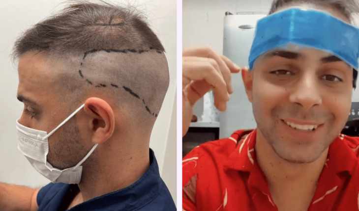 Grego Rosello se realizó un implante capilar y mostró el proceso: “Da un poco cringe”