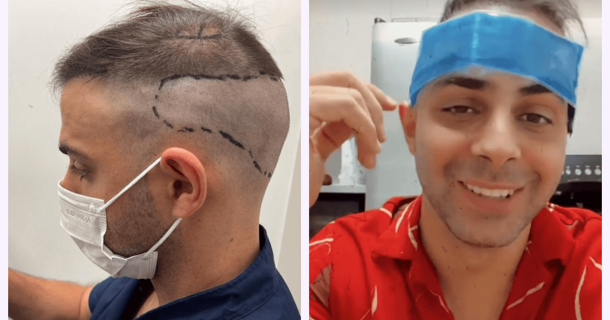 Grego Rosello se realizó un implante capilar y mostró el proceso: "Da un poco cringe"