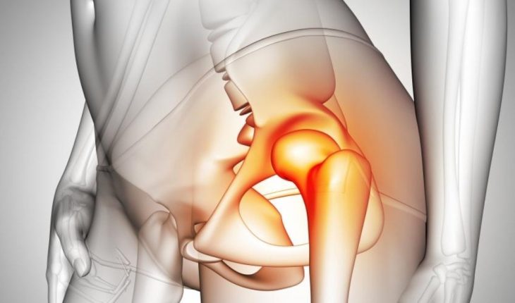 IPN desarrolla prótesis de cadera contra el osteosarcoma