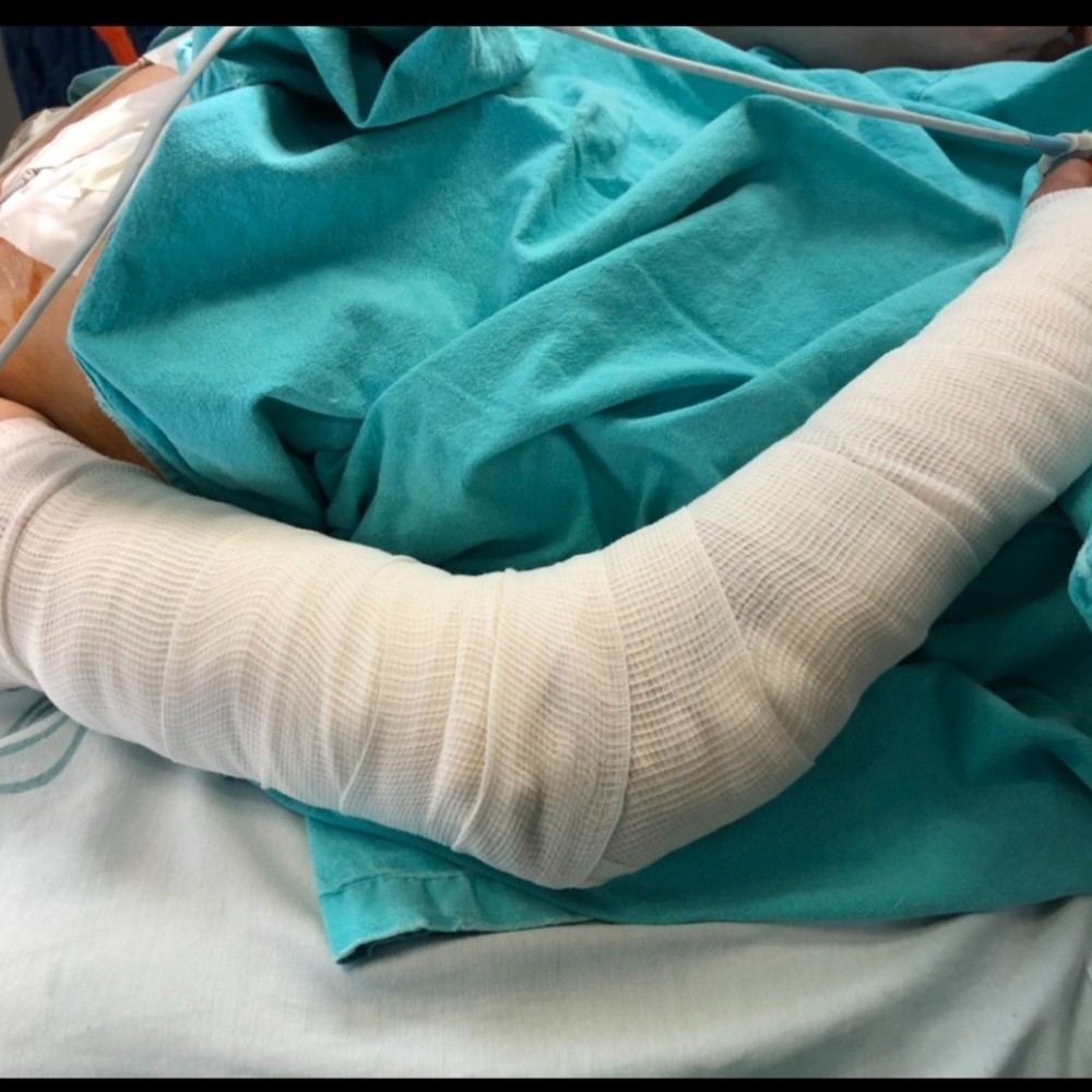 Evita IMSS amputación de brazo a joven tras 20 cirugías