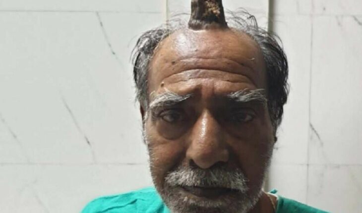 Man in India grows a horn on his head