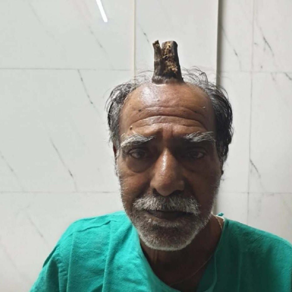 Man in India grows a horn on his head
