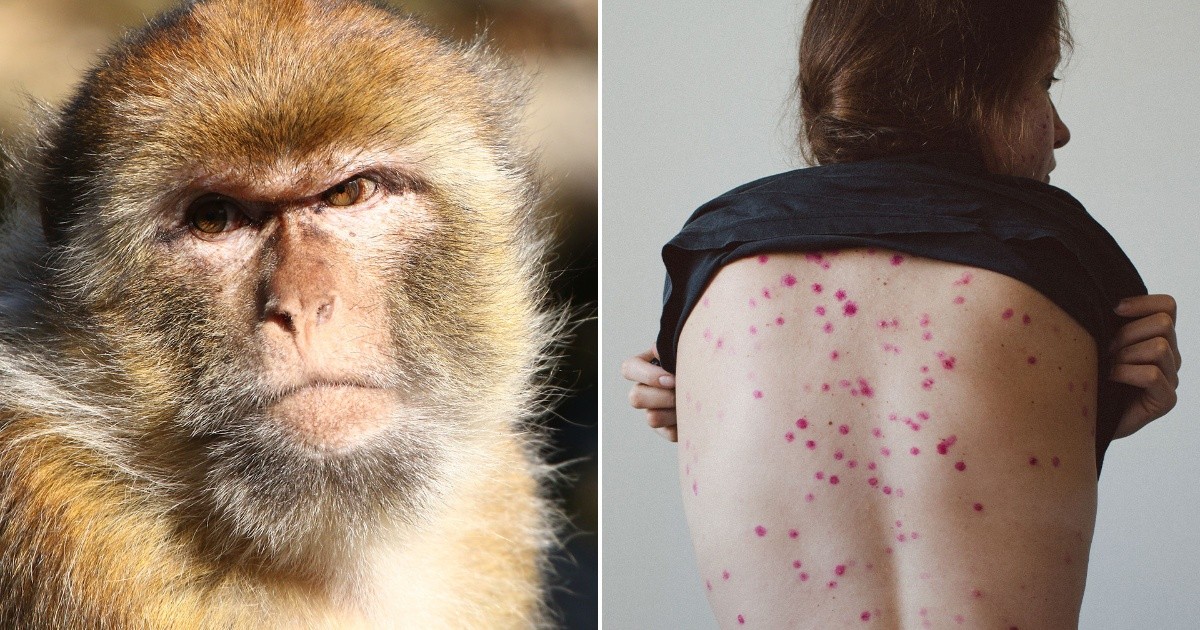 ¿La viruela de mono se puede contagiar a través de relaciones sexuales?