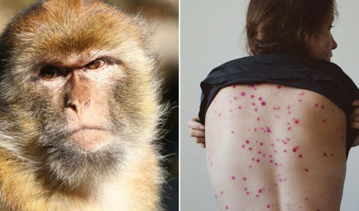 España detectó hoy 59 casos de viruela del mono