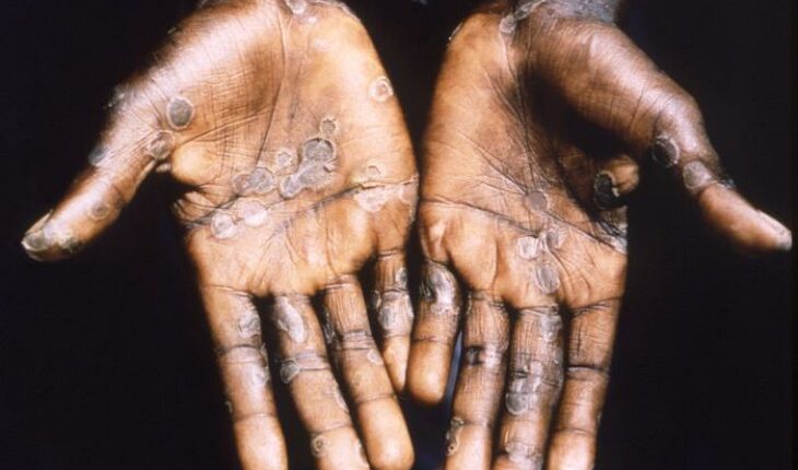 Mexico confirms the first case of monkeypox in the country