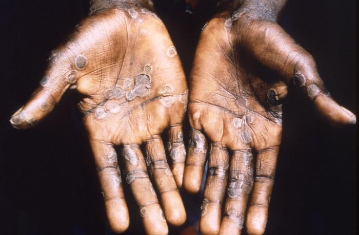 Mexico confirms the first case of monkeypox in the country