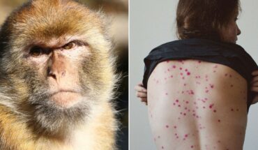 ¿La viruela de mono se puede contagiar a través de relaciones sexuales?