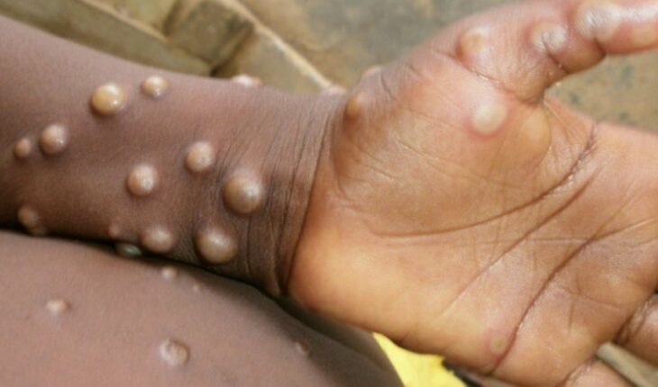 First case of monkeypox detected in Quintana Roo