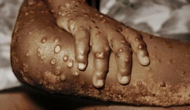 There are 788 cases of monkeypox in Mexico; an increase of 56% in one week
