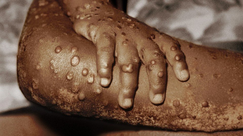 There are 788 cases of monkeypox in Mexico; an increase of 56% in one week