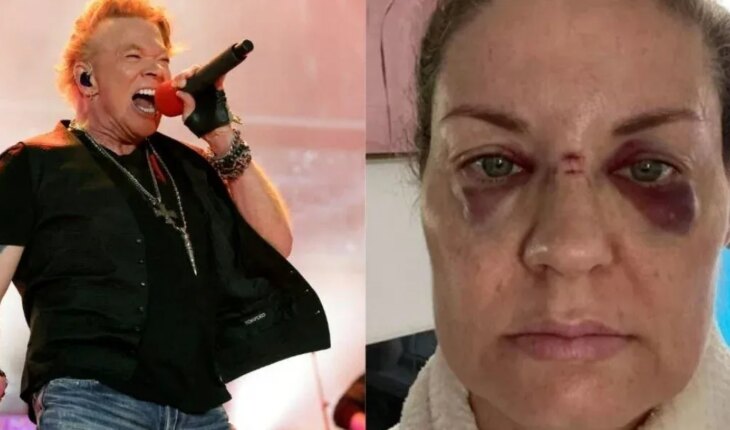 Axl Rose arrojó un micrófono al público y una mujer resultó herida: “Tengo la cara hundida”