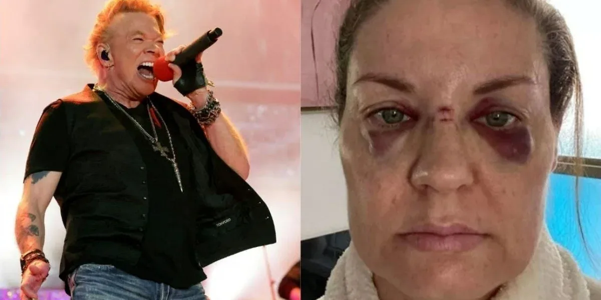 Axl Rose arrojó un micrófono al público y una mujer resultó herida: "Tengo la cara hundida"