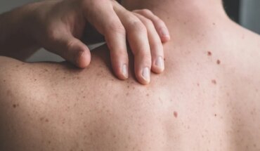 “MelaNOmás”: Decirle no más al melanoma depende de vos