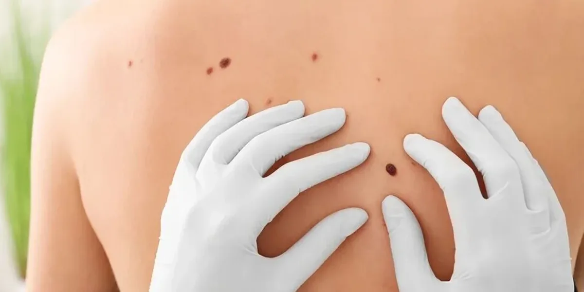 Campaña de prevención del cáncer de piel: realizarán chequeos gratuitos de lunares
