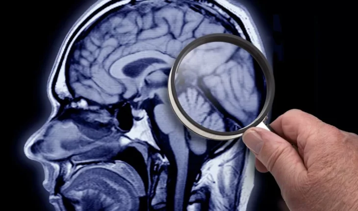 El estudio que encontró Alzheimer “transmisible” en personas que recibieron implantes de hormonas del crecimiento — Rock&Pop