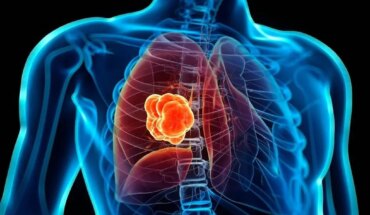 Argentina Makes New Lung Cancer Treatment Available