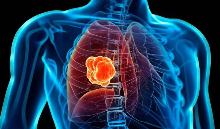 Argentina Makes New Lung Cancer Treatment Available