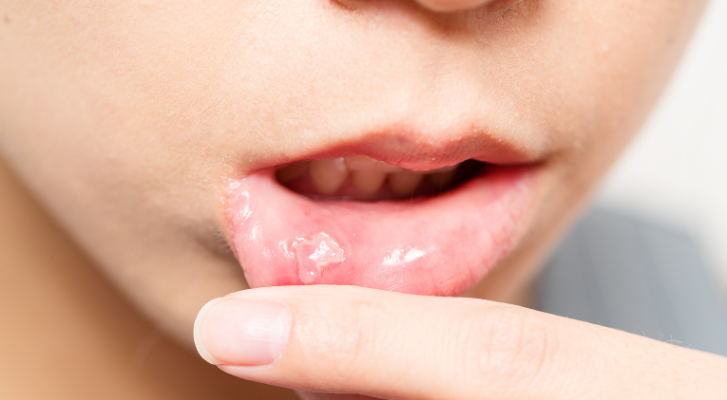 ¿Cómo curar úlceras O aftas en la boca? – MonitorExpresso.com