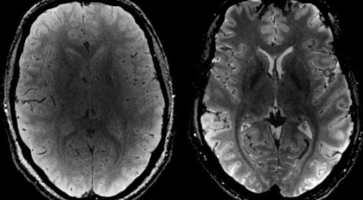 Primeras imágenes del cerebro con resonancia magnética potente – MonitorExpresso.com
