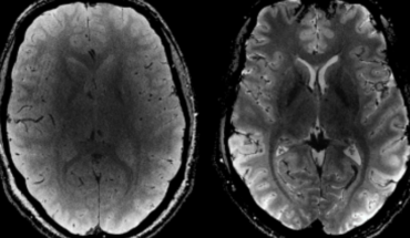 Primeras imágenes del cerebro con resonancia magnética potente – MonitorExpresso.com
